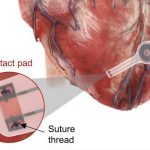 تولید اولین ضربان ساز مصنوعی قلب که در بدن حل می‌شود